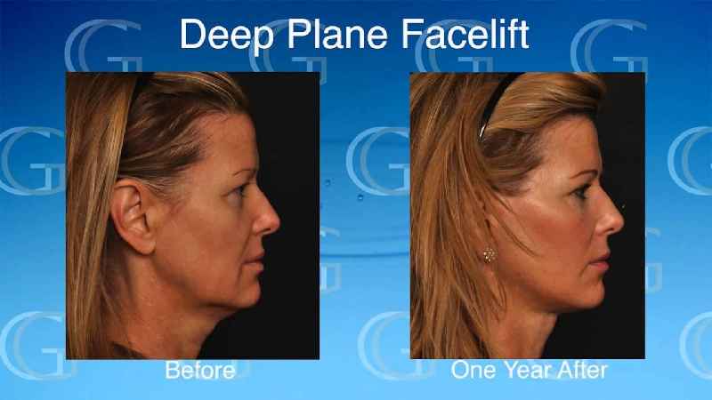 What is the difference between a mini facelift and a full facelift