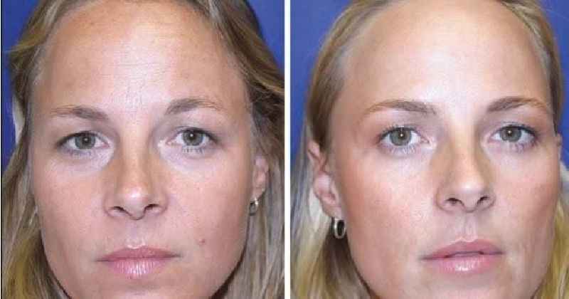 What is the difference between Botox Cosmetic and Botox Therapeutic