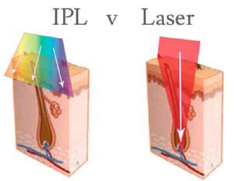 What is the difference between IPL and YAG laser