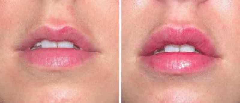 What is the difference between lip fillers and Russian lip fillers