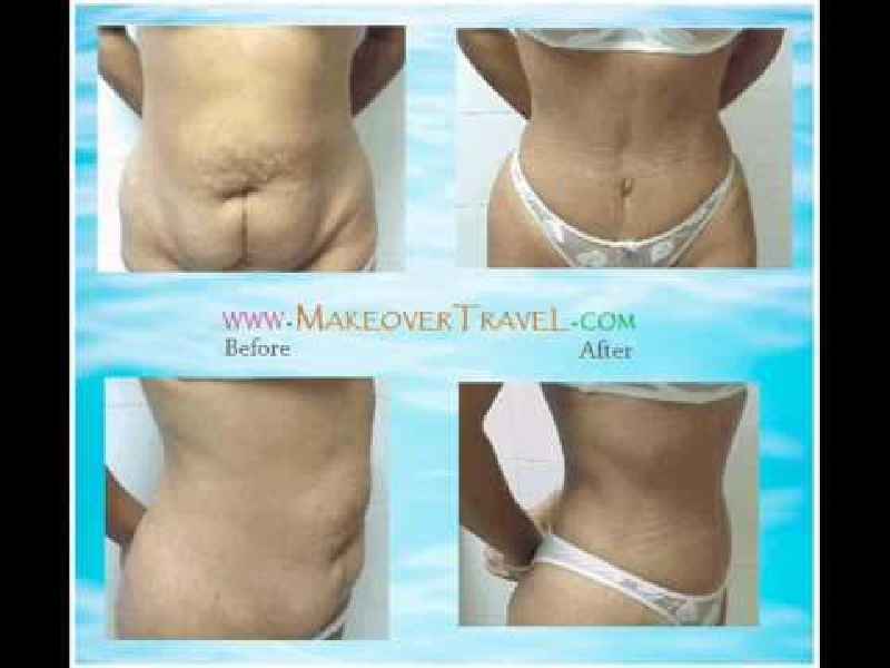 What is the difference between tummy tuck and Panniculectomy
