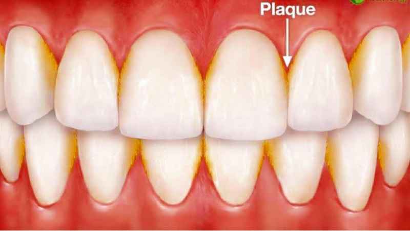 What is the difference between veneers and Invisalign