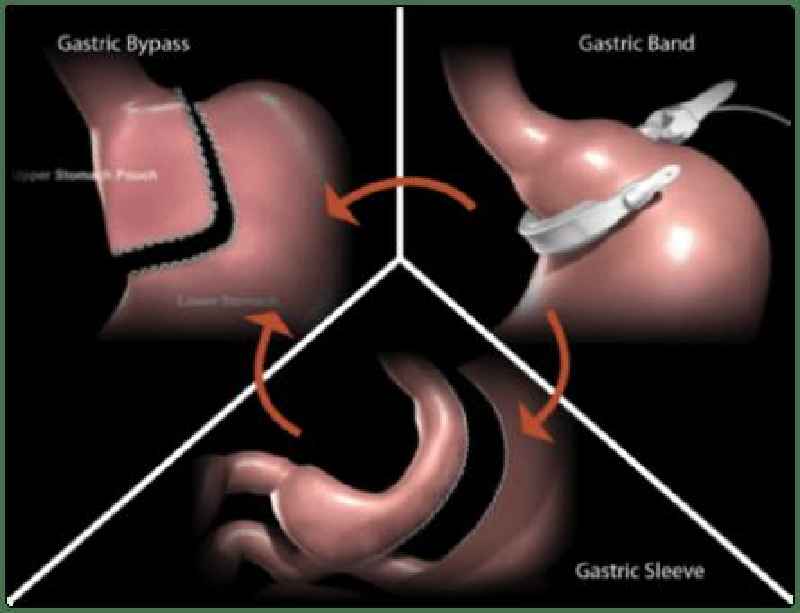 What is the failure rate of gastric bypass