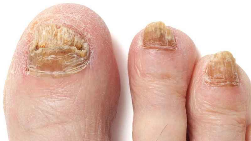 What is the fastest home remedy for toenail fungus