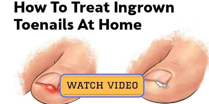 What is the fastest way to get rid of a ingrown toenail