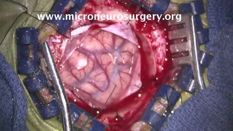 What is the first stage of brain tumor