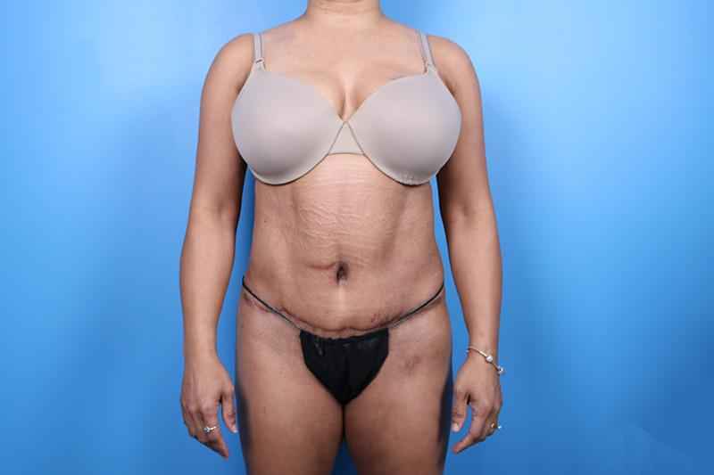 What is the highest BMI for a tummy tuck