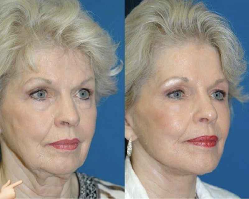 What is the least invasive face lift