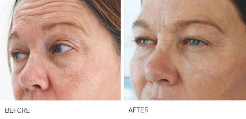 What is the longest lasting treatment for wrinkles