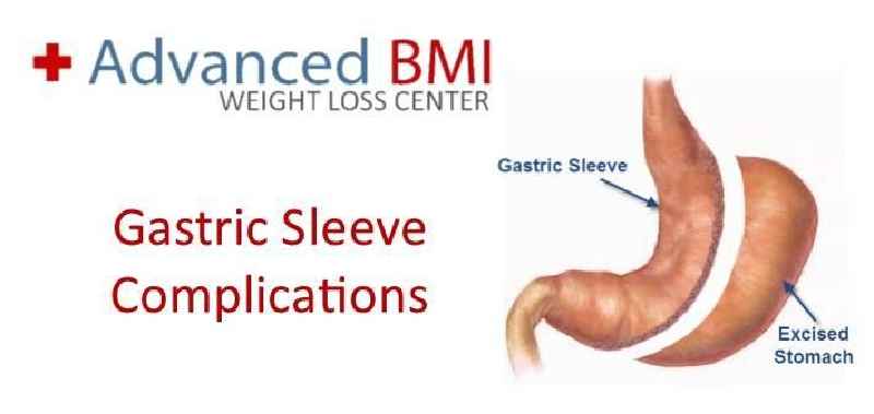 What is the lowest BMI for gastric sleeve