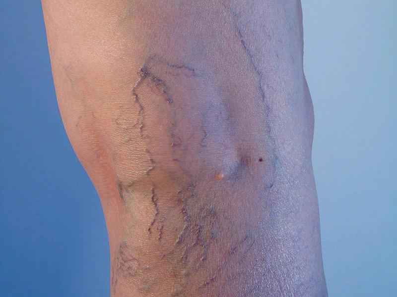 What is the main cause of varicose veins
