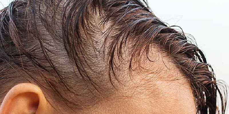 What is the main reason for hair loss in females