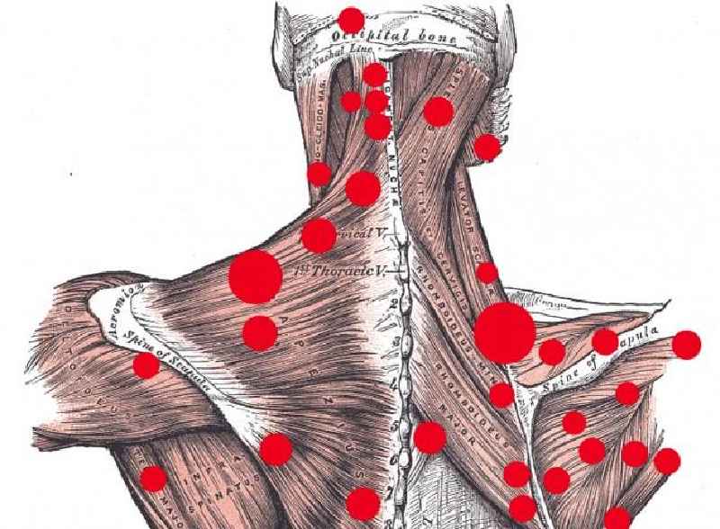 What is the most common characteristic of trigger point referral pain