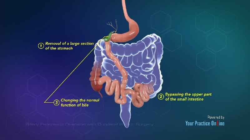 What is the most popular bariatric procedure