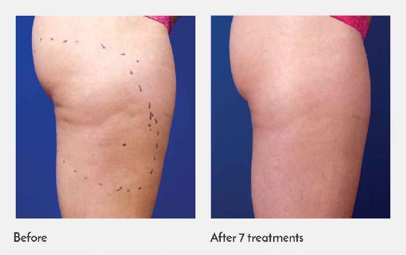 What is the newest skin tightening procedure