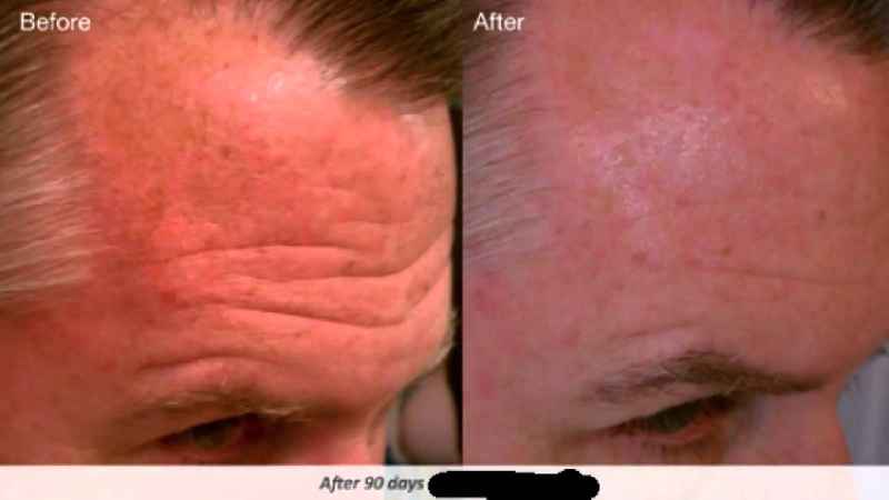 What is the newest treatment for wrinkles