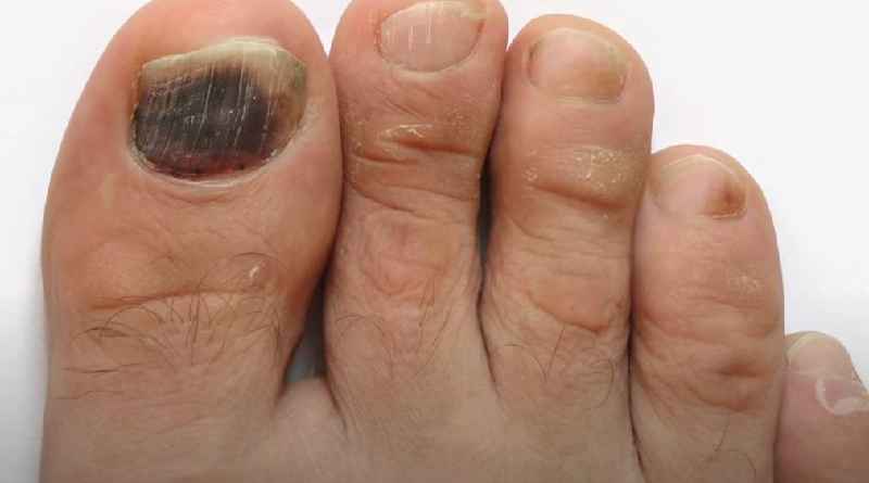 What is the root cause of toenail fungus