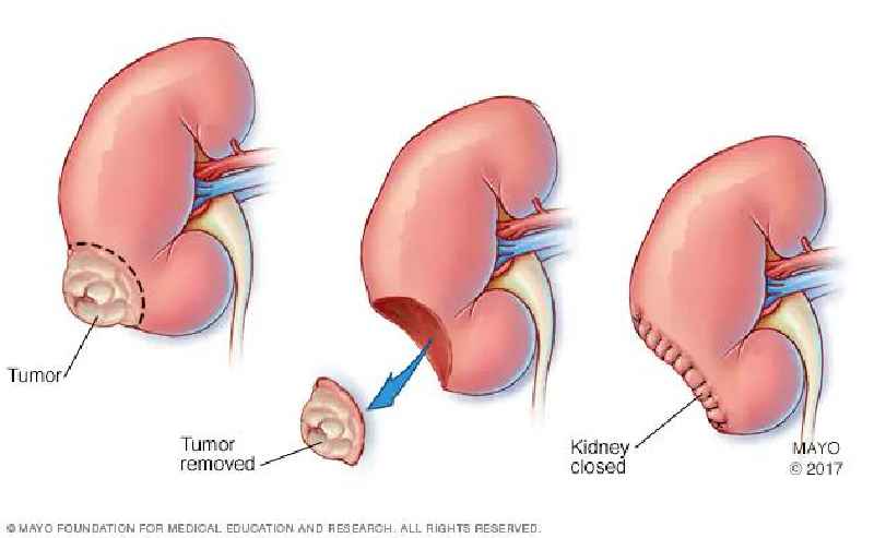 What is the root operation for a partial nephrectomy