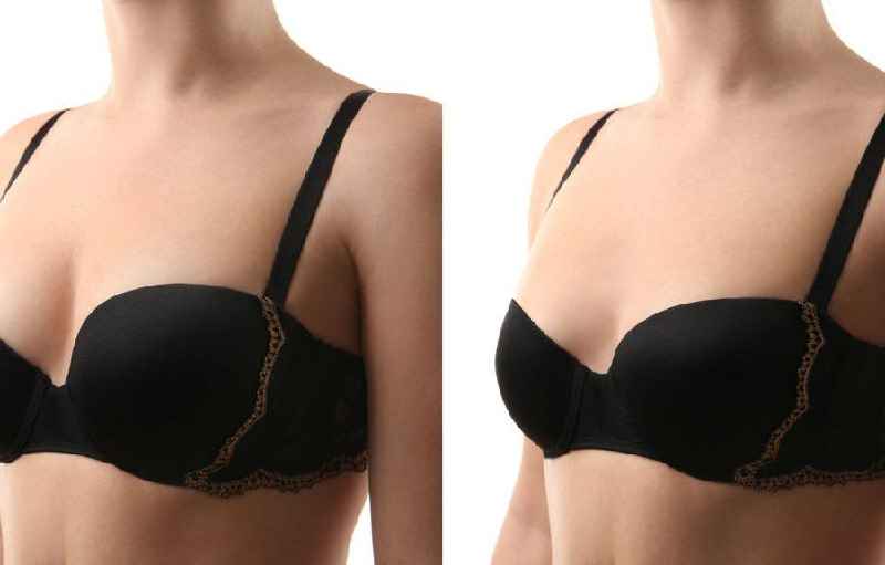 What is the root operation for breast augmentation