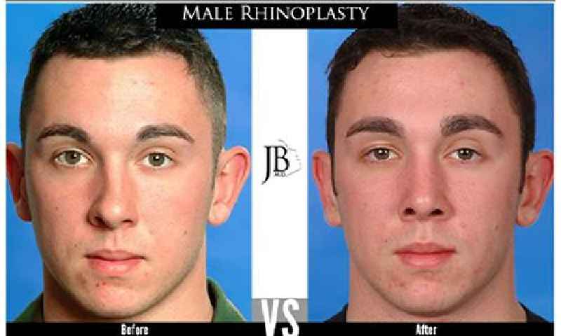 What is the root operation for rhinoplasty for cosmetic purposes