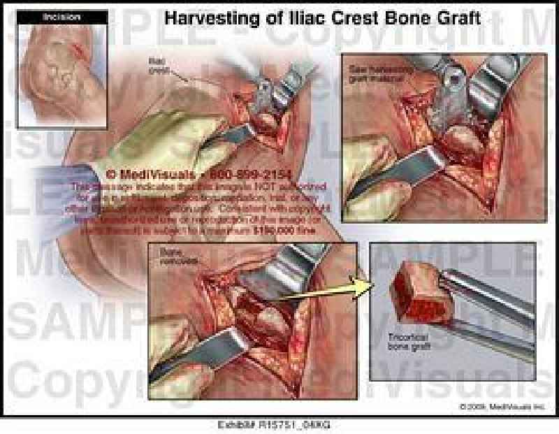 What is the root operation of a skin graft