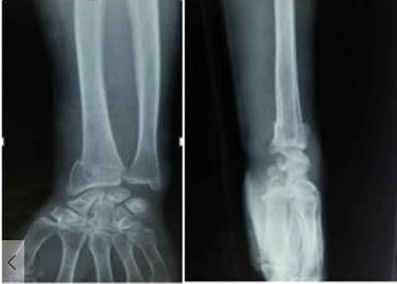What is the root operation used for reduction of a displaced fracture
