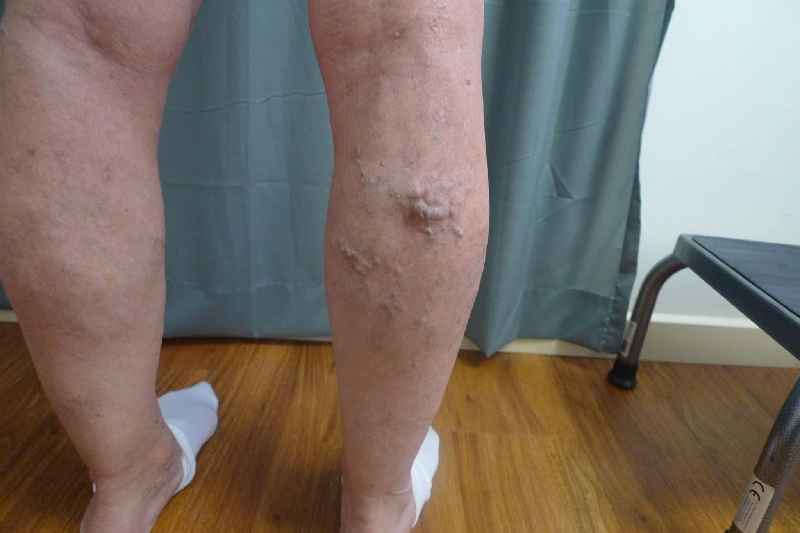 What is the safest treatment for varicose veins