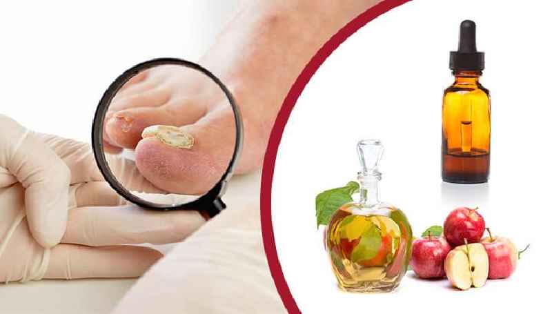 What is the strongest fungal nail treatment