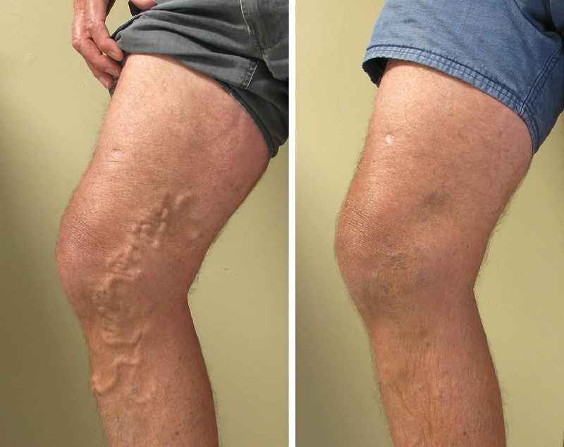 What is the success rate of laser treatment for varicose veins