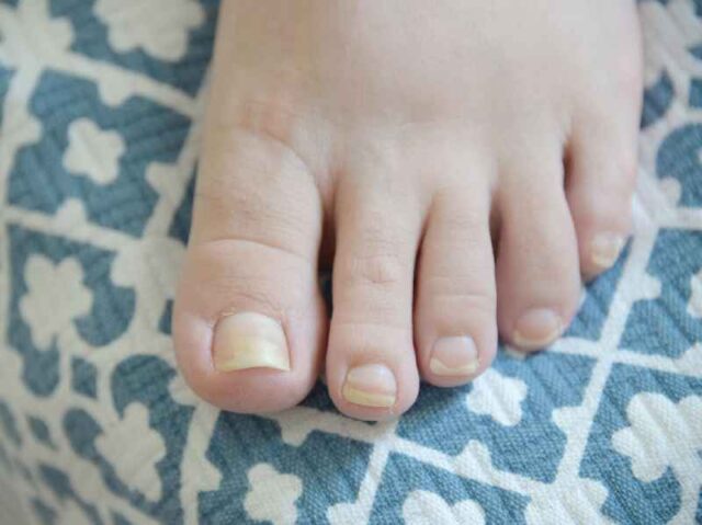 how-to-care-for-toe-after-nail-falls-off