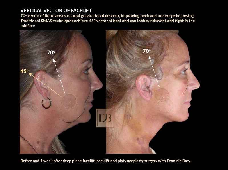 What is vertical restore facelift