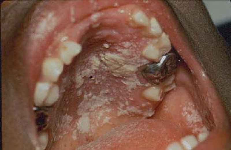 What kills infection in mouth