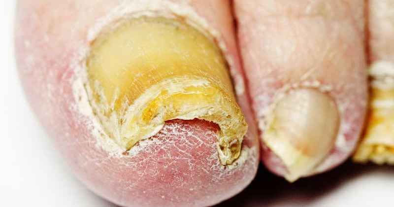 What kills toe fungus naturally