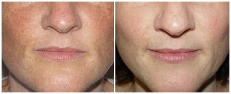 What laser treatment reduce pore size