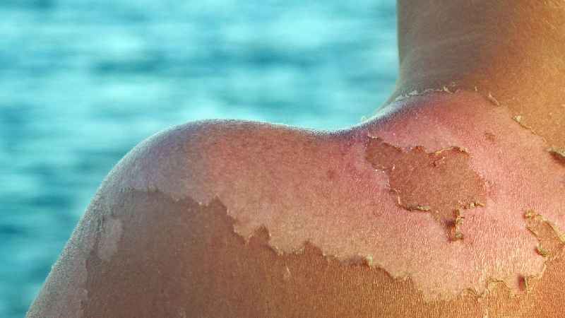 What Moisturiser is best for sunburn