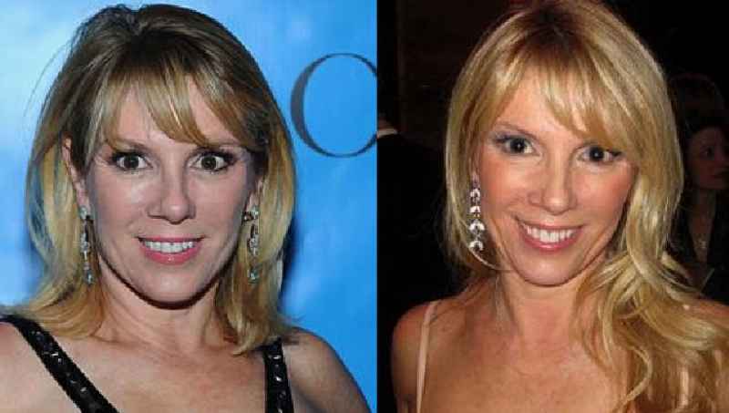 What plastic surgery did Ramona Singer Get