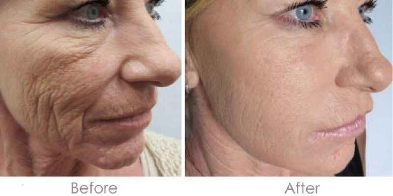 What procedure improves skin texture