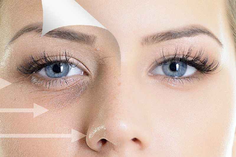 What's better for under eyes Juvederm or Restylane