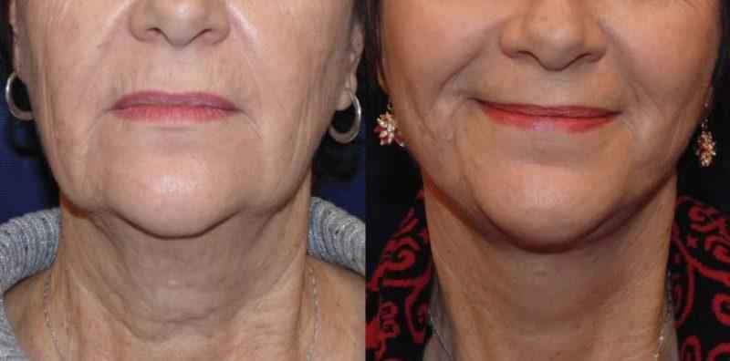 What's the difference between a facelift and a mini facelift