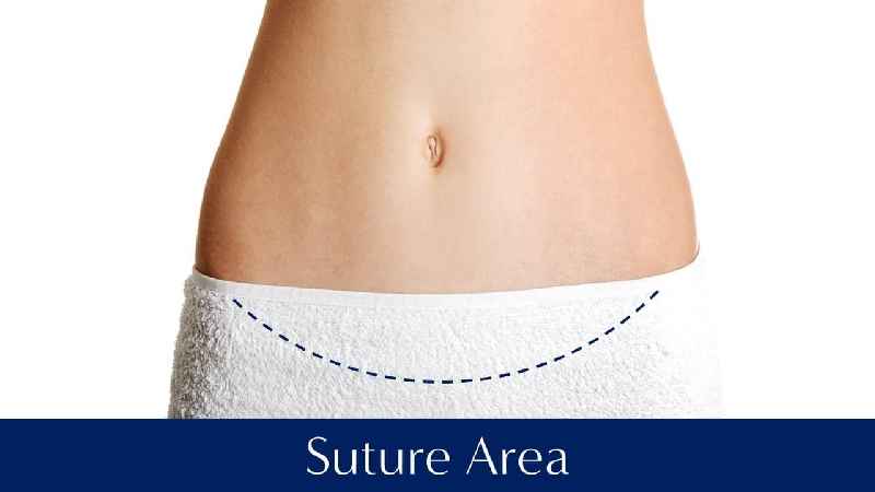 What's the difference between a regular tummy tuck and extended tummy tuck