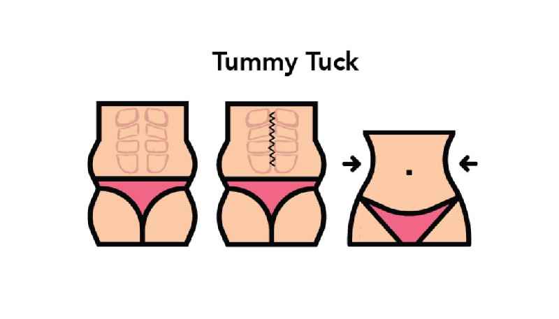 What's the difference between a tummy tuck and liposuction