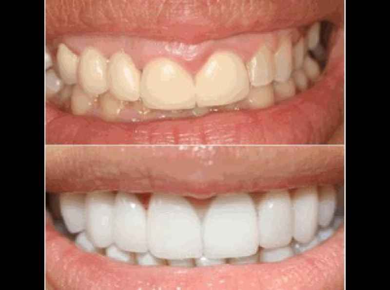 What's the difference between porcelain and composite veneers