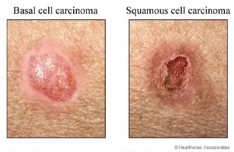 What's worse basal cell or squamous