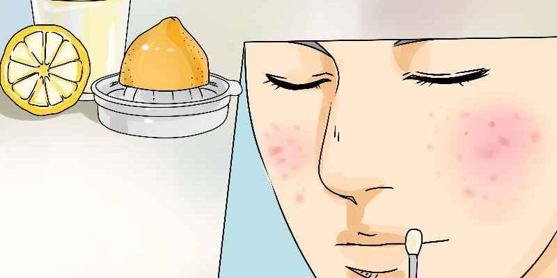 What should I avoid to prevent pimples