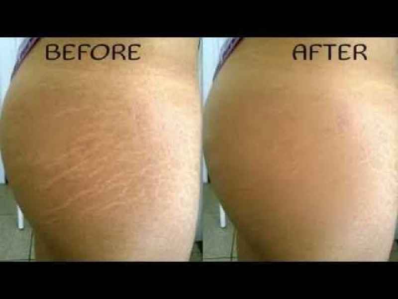 What should I do after microneedling stretch marks