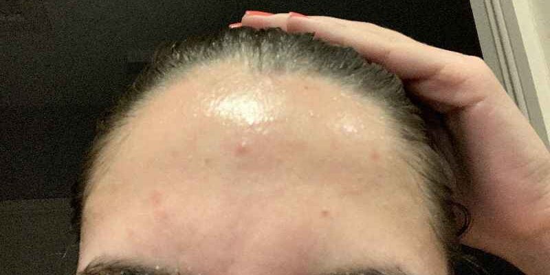 What should I do daily for acne