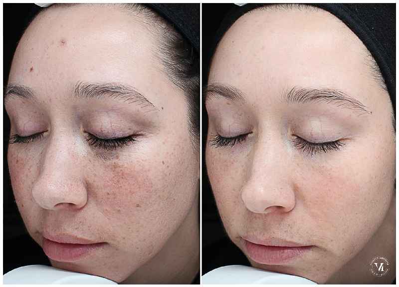 How to care for face after chemical peel?