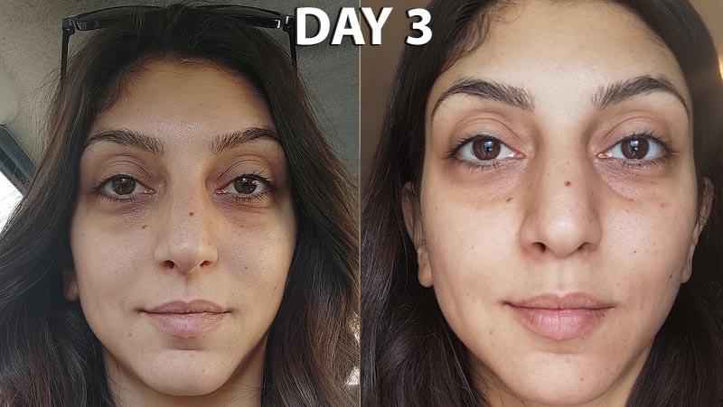 What should you not do after microneedling
