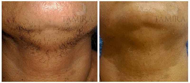 What should you not do before laser hair removal