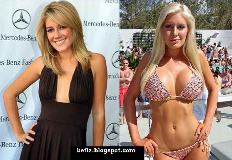 What size breast implants did Heidi Montag get